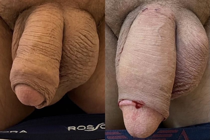Ingrossamento pene prima e dopo - 828911