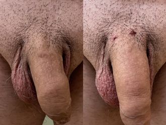 Ingrossamento pene prima e dopo - 828914