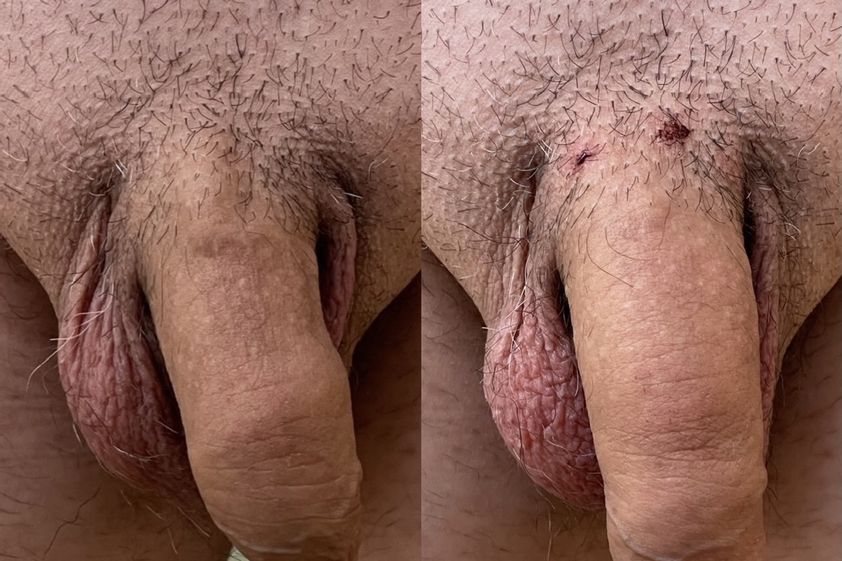Ingrossamento pene prima e dopo - 828914