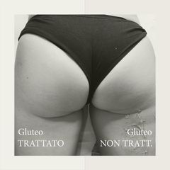 Cellulite - Dott.ssa Raffaella Lavinia Fassi