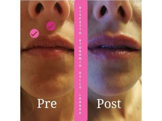 Filler labbra - Dr. Giuseppe Cuccia