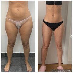 Liposuzione - Dr. Giuseppe Cuccia