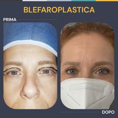 Blefaroplastica - Dr. Giuseppe Cuccia