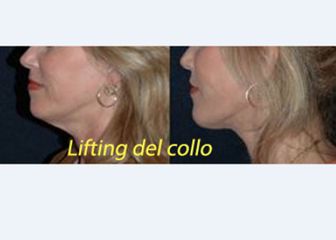 Lifting collo prima dopo