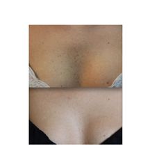 Macchie décolleté prima dopo