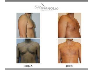 Ginecomastia prima e dopo