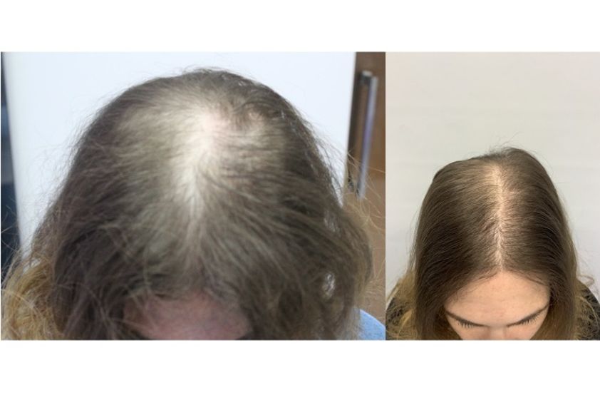 Alopecia prima e dopo - 767121