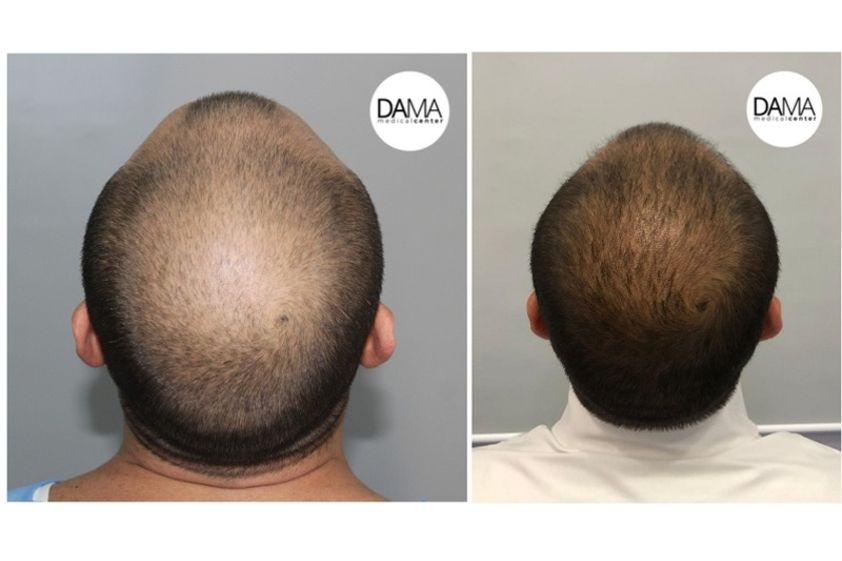 Alopecia prima e dopo - 767259