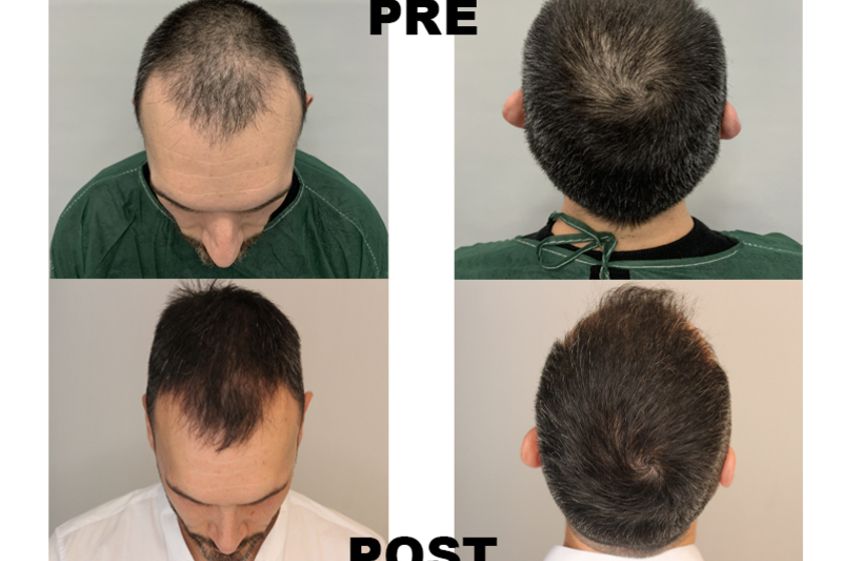 Alopecia prima e dopo - 767279