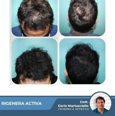 Trapiano capelli - Dott. Dario Martusciello - Dama Medical Center