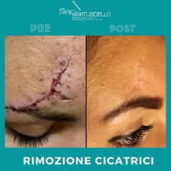 Dott. Dario Martusciello Rimozione Cicatrice