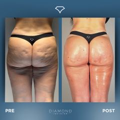 Dott. Dario Martusciello Diamond Incision