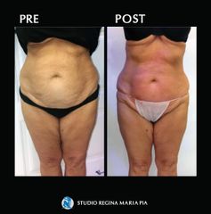 Liposuzione - Studio Regina Maria Pia