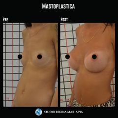 Mastoplastica additiva - Studio Regina Maria Pia