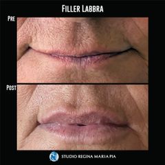 Filler labbra - Studio Regina Maria Pia