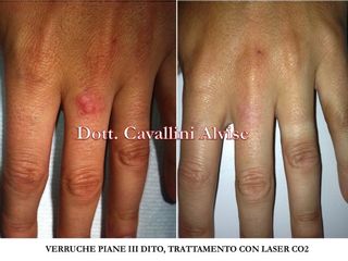 Verruche prima e dopo