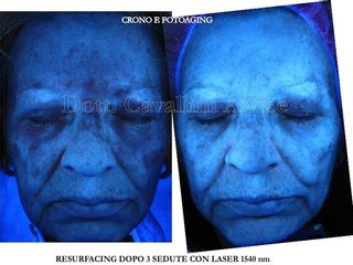 Melasma prima e dopo