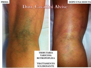 Scleroterapia prima e dopo