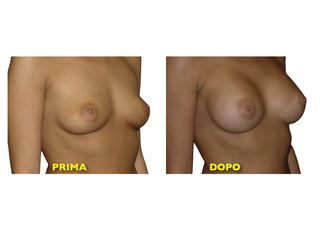 Mastoplastica additiva prima e dopo