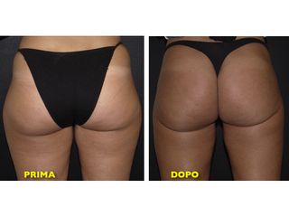 Liposcultura prima e dopo