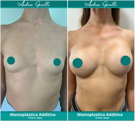 Mastoplastica additiva - Dott. Andrea Garelli