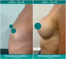 Mastoplastica additiva - Dott. Andrea Garelli