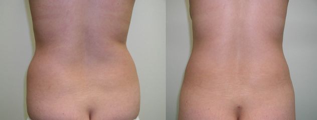 liposuzione prima dopo