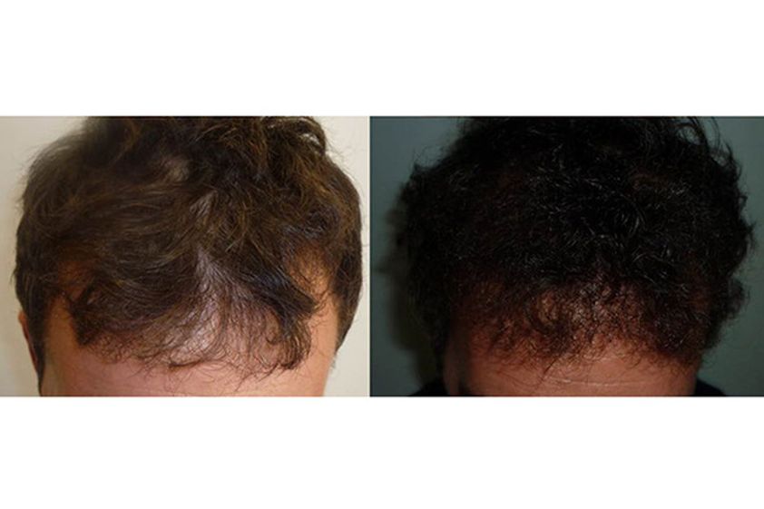 Trapianto capelli prima e dopo - 756947