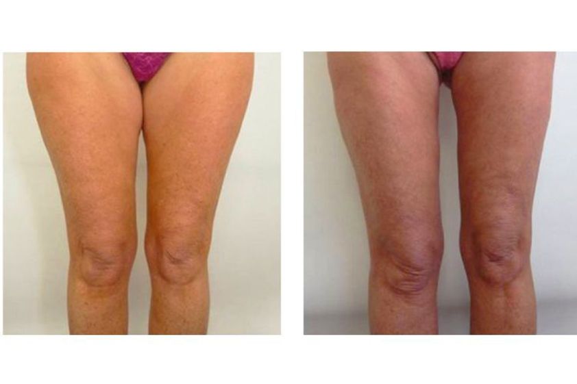 Cellulite prima e dopo - 772152