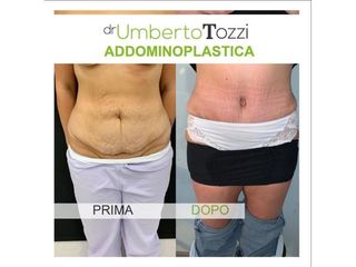 Addominoplastica - Dott. Lino Bertolini