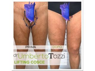 Lifting cosce - Dott. Umberto Tozzi