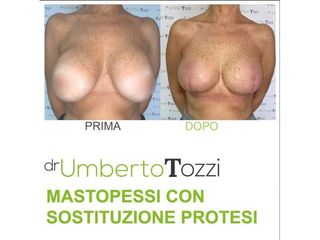 Sostituzione protesi - Dott. Umberto Tozzi