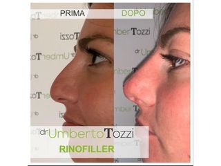 Rinofiller - Dott. Umberto Tozzi