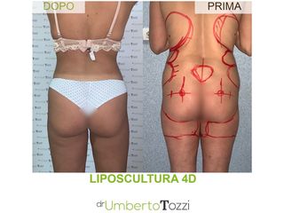 Liposcultura - Dott. Umberto Tozzi