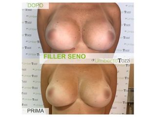 Filler seno - Dott. Umberto Tozzi - Clinique Visage