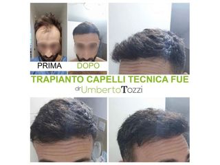 Trapianto capelli - Dott. Umberto Tozzi
