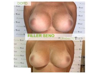 Filler seno - Dott. Umberto Tozzi - Clinique Visage