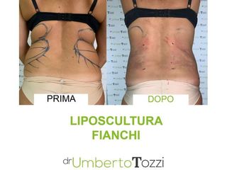 Liposcultura - Dott. Umberto Tozzi - Clinique Visage
