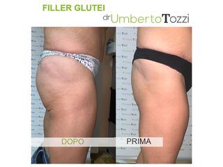 Gluteoplastica - Dott. Umberto Tozzi