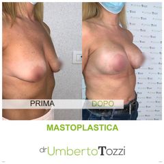 Mastoplastica additiva - Dott. Umberto Tozzi - Clinique Visage