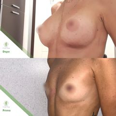 Mastoplastica additiva - Dott. Umberto Tozzi