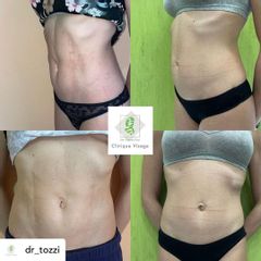 Liposcultura HD - Dott. Umberto Tozzi