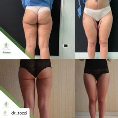 Vaser Lipo - Dott. Umberto Tozzi