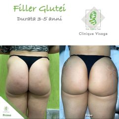 Filler glutei - Dott. Umberto Tozzi - Clinique Visage