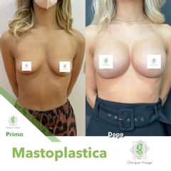 Mastoplastica additiva - Dott. Umberto Tozzi - Clinique Visage