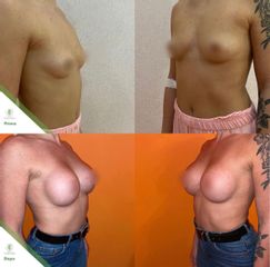 Mastoplastica additiva - Dott. Umberto Tozzi - Clinique Visage