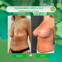 Mastoplastica additiva - Dott. Umberto Tozzi - Clinique Visage