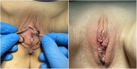Labioplastica - Dott. Umberto Tozzi - Clinique Visage