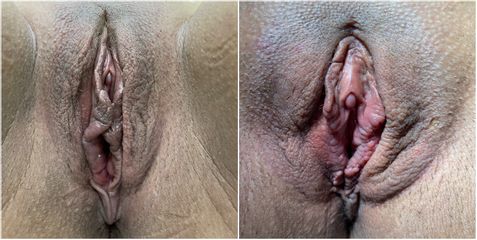 Labioplastica - Dott. Umberto Tozzi - Clinique Visage