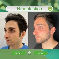 Rinoplastica - Dott. Umberto Tozzi - Clinique Visage